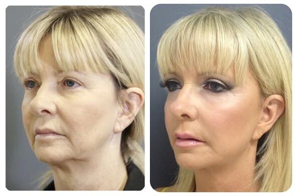 vor und nach Hautverjüngung mit Fotofestigung 2