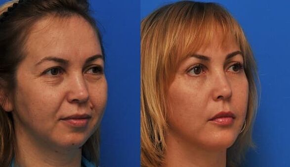 vor und nach Hautverjüngung mit straffender Foto 1