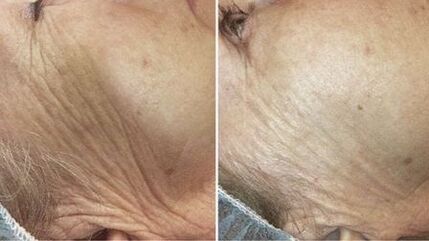 vor und nach der Laser-Hautverjüngung