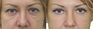 Fotos vor und nach der Augenlidkonturierung